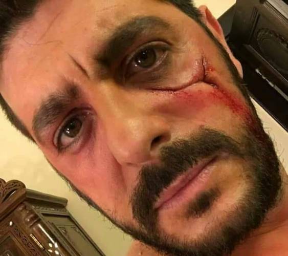 حقيقة تعرض طوني عيسى لضربة سكين في وجهه