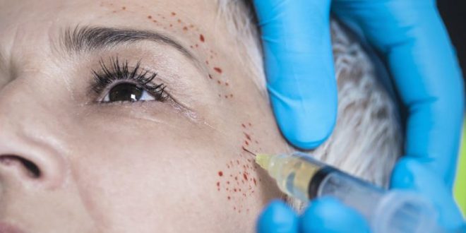 "بلازما الدم".. تقنية تجميلية لمحو آثار حب الشباب
