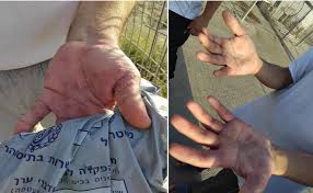 مرض الجرب يتفشى في سجني النقب وعوفر وسط استمرار جرائم الاحتلال بحق الأسرى