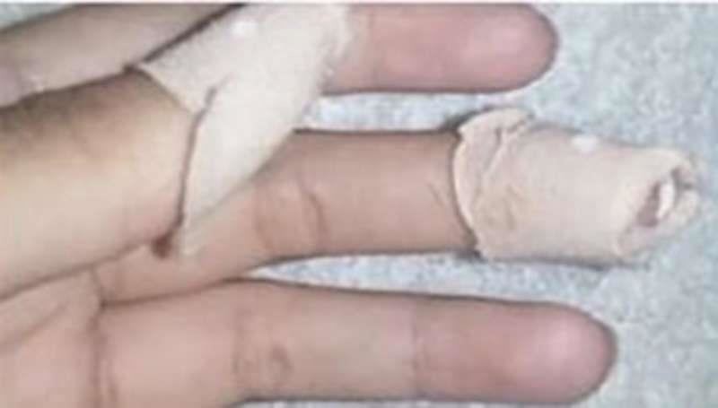 معلمة تقتلع أظافر طالبة في المدرسة