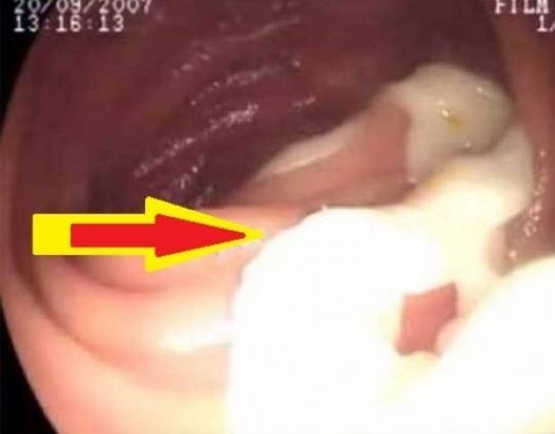 عانى من ألم في المعدة لمدة عامين.. ما اكتشفه الأطباء أرعبهم!