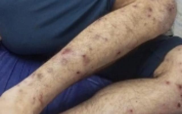 شهادات مروعة من سجن "عوفر": انتشـار كـارثي لـمرض "الجرب" كأداة تعذيب والأسرى ينامون على ملابسهم
